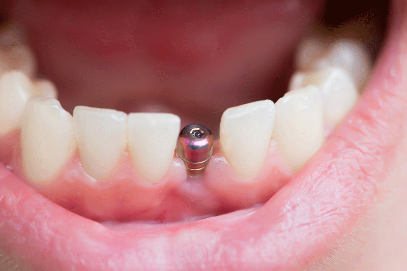 an image of a dental implant in a mouth.