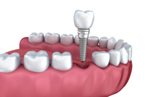 dental implants.