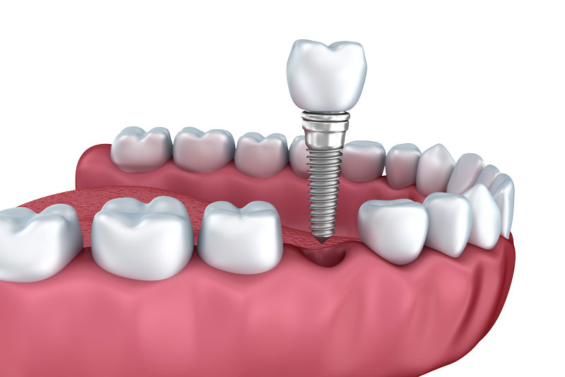 dental implants.