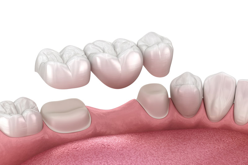 3D illustration showing a dental bridge being placed to replace a missing tooth, supported by two prepared teeth on either side in Albuquerque NM